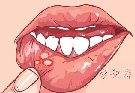 口腔溃疡怎么治好的最快，6种口腔溃疡有效治疗方法