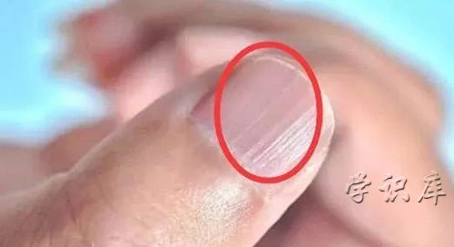 指甲有竖纹是身体的什么信号，指甲竖纹的6个警示