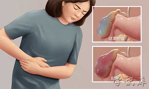 胆囊炎的症状是哪里疼 胆囊炎的症状表现