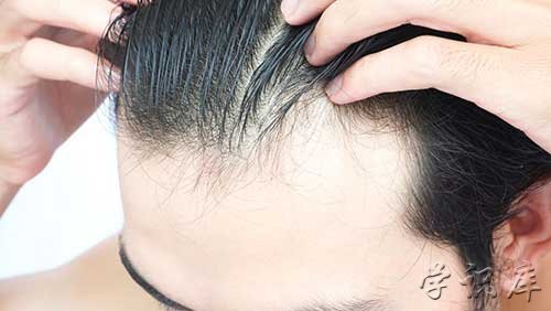 头发稀疏怎么恢复 头发稀疏怎样能变得密