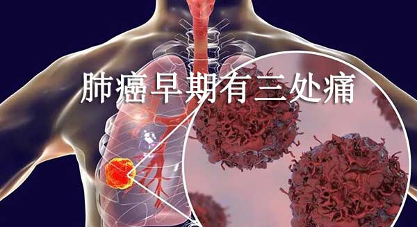 肺癌早期有三处痛，肺癌早期3个信号