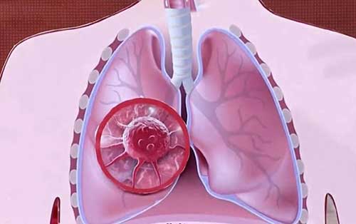 肺癌的早期症状和前兆，7个早期肺癌的信号