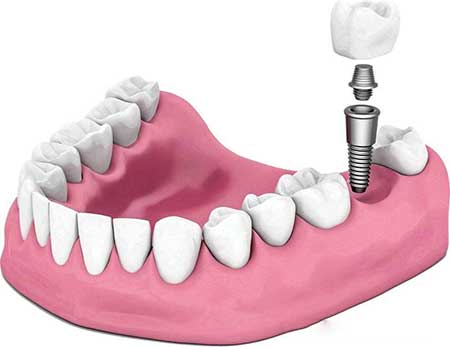 种植牙的过程步骤，6个种植牙齿的流程